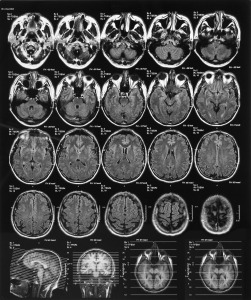 x-ray film of the brain computed tomography